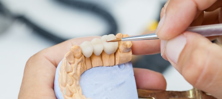 Dental Bridges