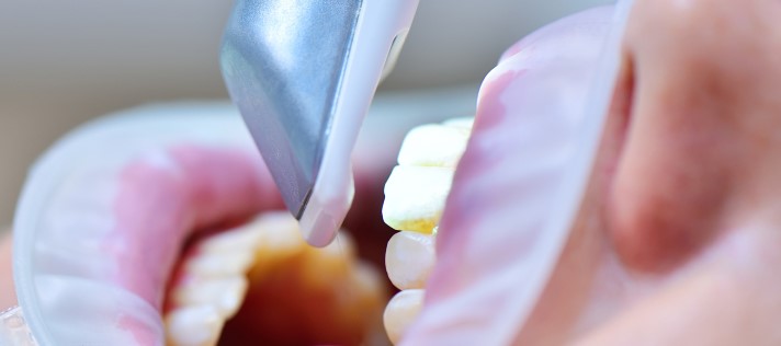 Teeth Whitening